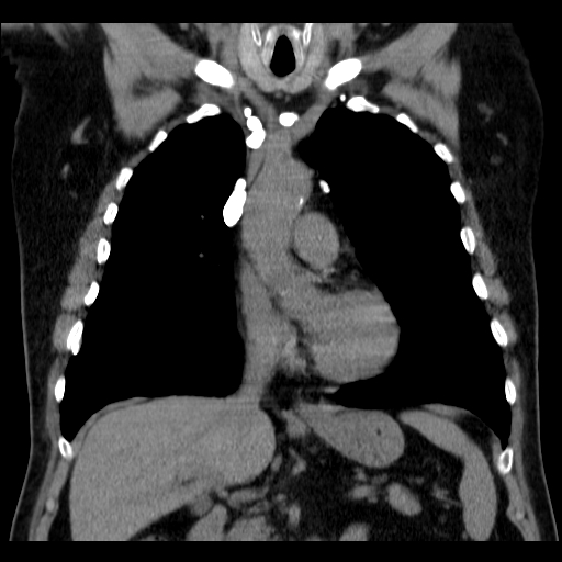 File:Classic complicated silicosis (Radiopaedia 49720-54961 Coronal liver window 24).jpg