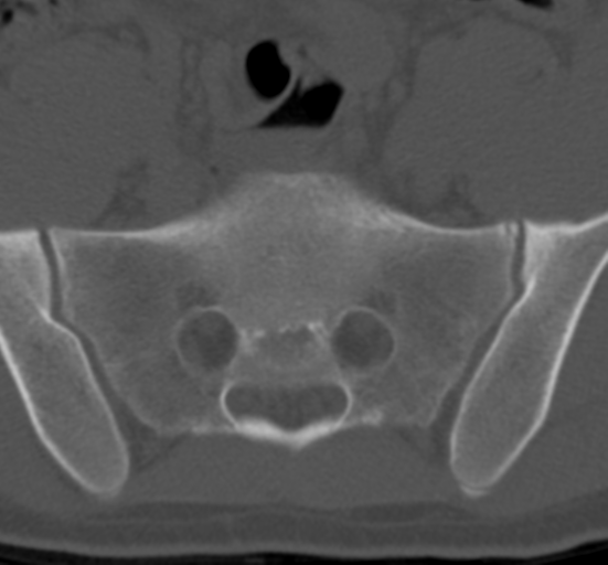 Clear cell meningoma - lumbar spine (Radiopaedia 60116-67691 Axial bone window 73).png