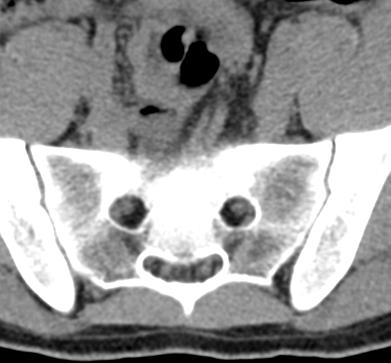 File:Clear cell meningoma - lumbar spine (Radiopaedia 60116-67691 Axial non-contrast 75).png