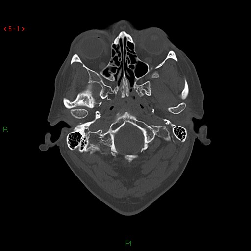 File:Clipping of an internal carotid artery aneurysm (Radiopaedia 15638).jpg