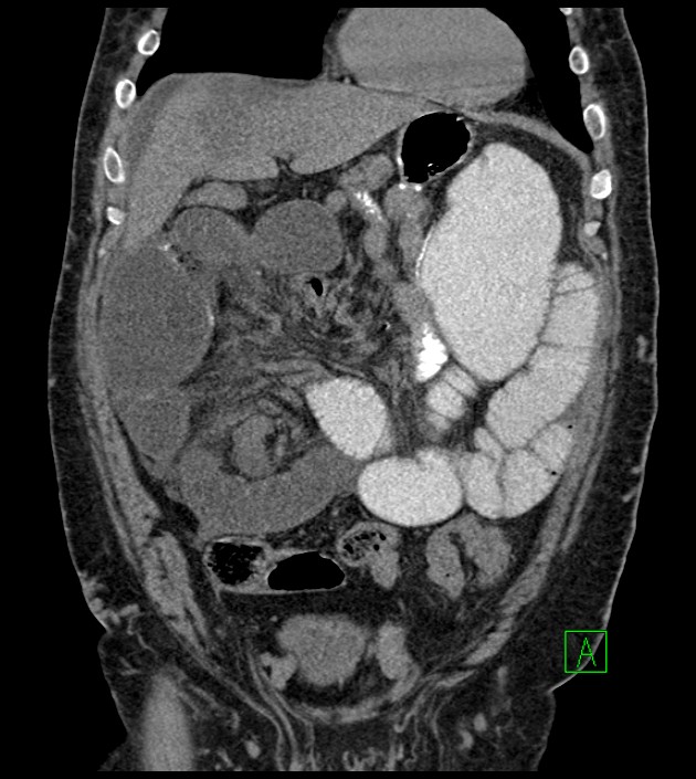 Closed-loop small bowel obstruction-internal hernia (Radiopaedia 78439-91096 Coronal non-contrast 36).jpg