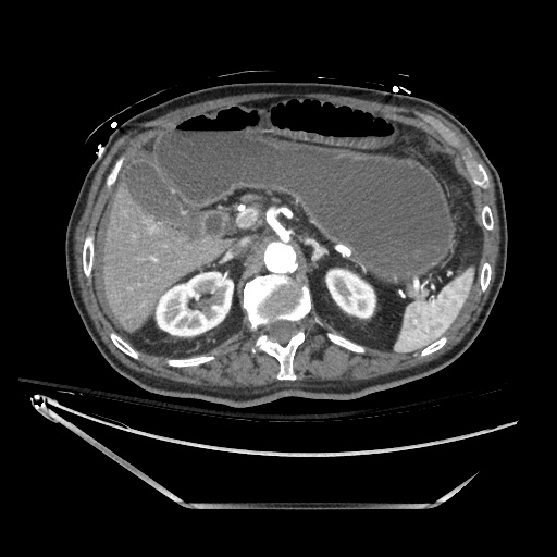File:Closed loop obstruction due to adhesive band, resulting in small bowel ischemia and resection (Radiopaedia 83835-99023 Axial 295).jpg