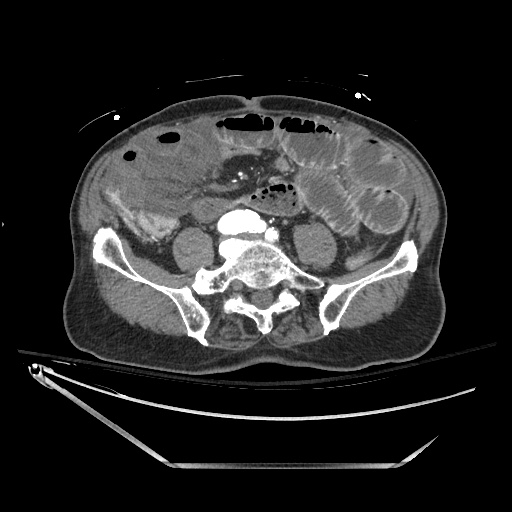 File:Closed loop obstruction due to adhesive band, resulting in small bowel ischemia and resection (Radiopaedia 83835-99023 B 101).jpg