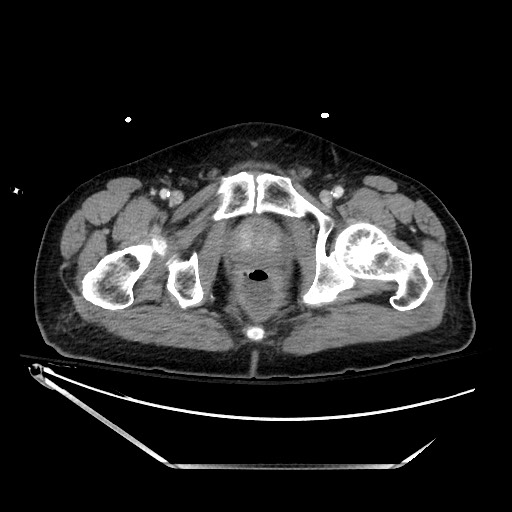 File:Closed loop obstruction due to adhesive band, resulting in small bowel ischemia and resection (Radiopaedia 83835-99023 D 154).jpg