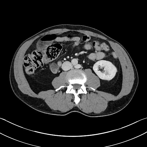 Closed loop small bowel obstruction - internal hernia (Radiopaedia 57806-64778 B 64).jpg