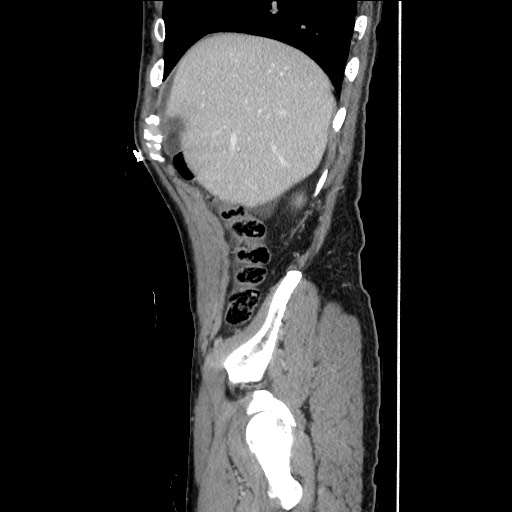 Closed loop small bowel obstruction - omental adhesion causing "internal hernia" (Radiopaedia 85129-100682 C 43).jpg