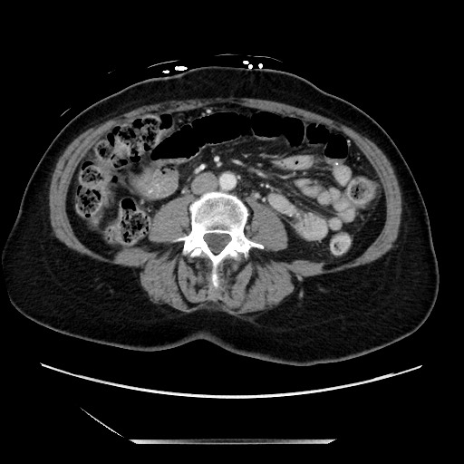 Closed loop small bowel obstruction due to adhesive bands - early and late images (Radiopaedia 83830-99014 A 79).jpg