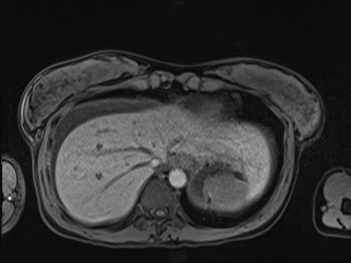 Closed loop small bowel obstruction in pregnancy (MRI) (Radiopaedia 87637-104031 Axial T1 fat sat 18).jpg