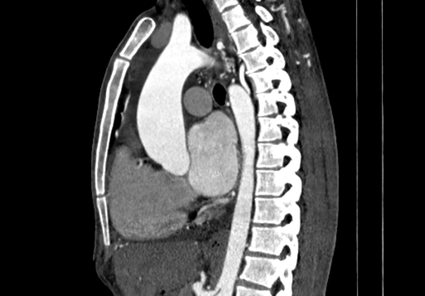Coarctation of aorta with aortic valve stenosis (Radiopaedia 70463-80574 B 64).jpg
