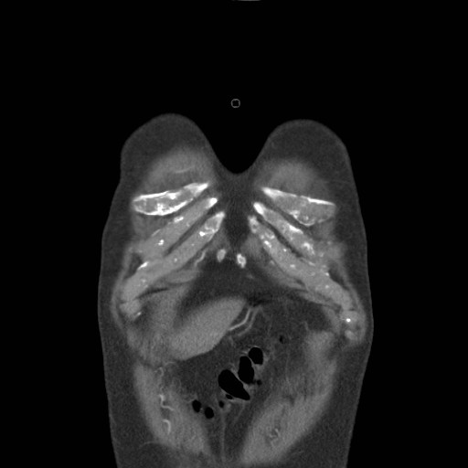 File:Coarctation of the aorta (Radiopaedia 17427-17116 A 80).jpg