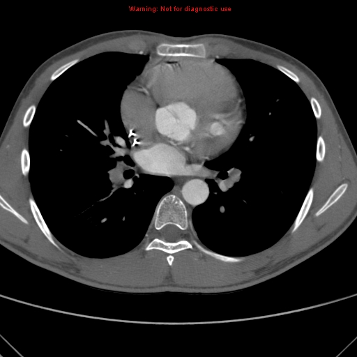 File:Coarctation of the aorta (Radiopaedia 9434-10118 A 102).jpg