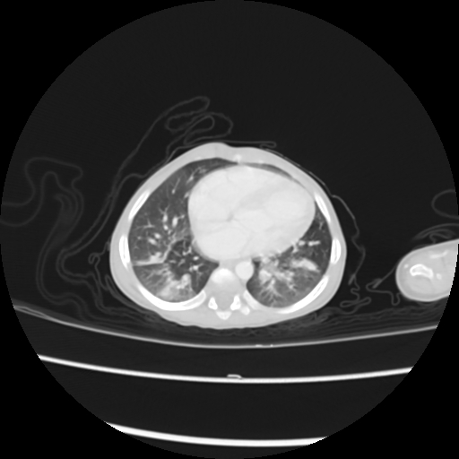 Coarctation of the aorta and patent ductus arteriosus (Radiopaedia 68033-77499 Axial lung window 40).jpg