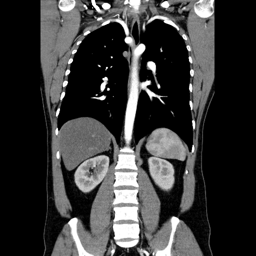 File:Codominant double aortic arch (Radiopaedia 56012-62637 B 30).jpg