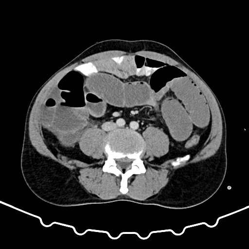 Colocolic intussusception due to large lipoma (Radiopaedia 68773-78482 A 118).jpg
