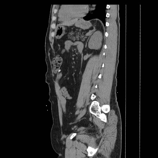 File:Colocutaneous fistula in Crohn's disease (Radiopaedia 29586-30093 C 36).jpg