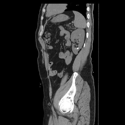 File:Colocutaneous fistula in Crohn's disease (Radiopaedia 29586-30093 C 47).jpg