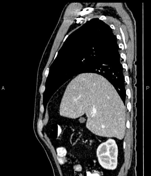 Colon adenocarcinoma (Radiopaedia 83266-97671 D 31).jpg