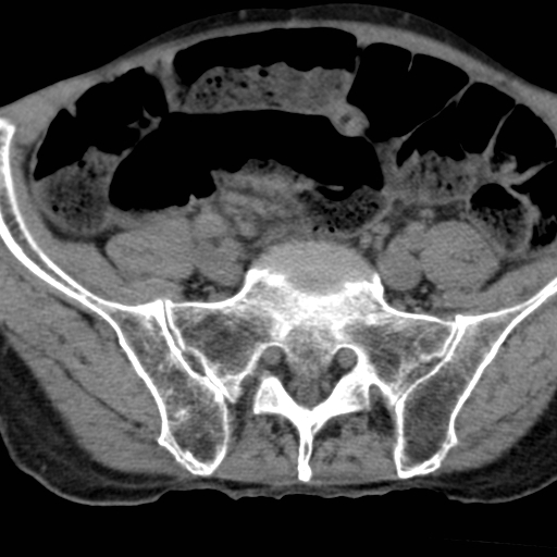 File:Colon cancer with calcified liver metastasis (Radiopaedia 74423-85309 Axial non-contrast 83).jpg