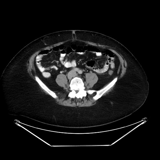 File:Colonic intussusception due to adenocarcinoma (Radiopaedia 86828-102987 A 97).jpg