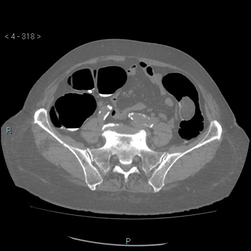 Colonic lipomas (Radiopaedia 49137-54244 Axial bone window 142).jpg
