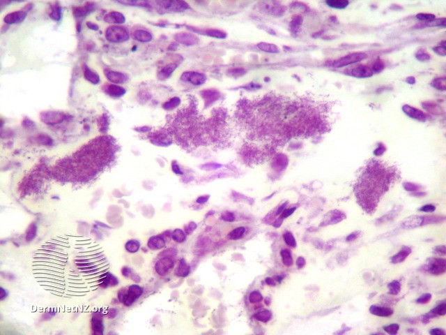 File:Figure 3 (DermNet NZ pathology-e-bacillary-angiomatosis-fig-3).jpg