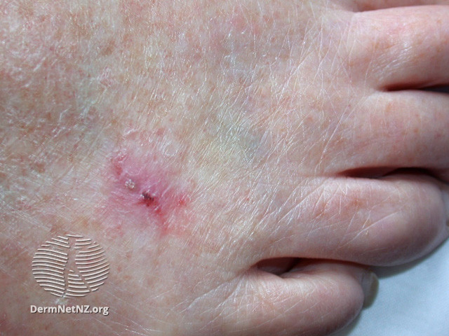 Intraepidermal carcinoma (DermNet NZ lesions-scc-in-situ-2964).jpg