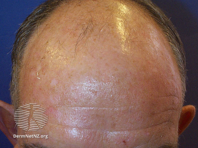 File:Male pattern balding (DermNet NZ hair-nails-sweat-male-balding).jpg