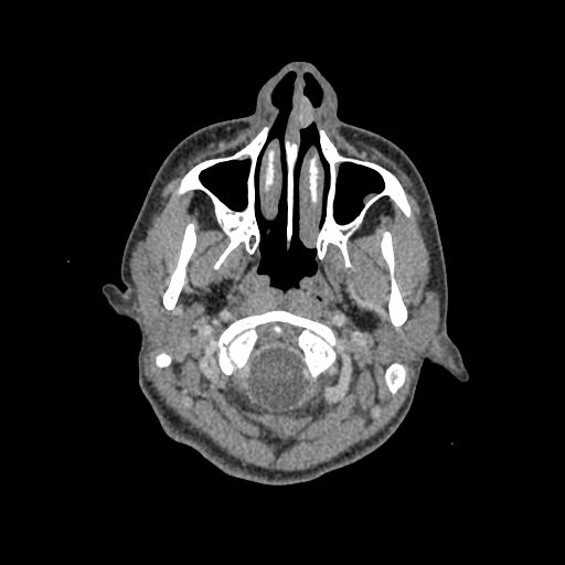 Nasal pyogenic granuloma (lobular capillary hemangioma) (Radiopaedia 85536-101244 C 23).jpg