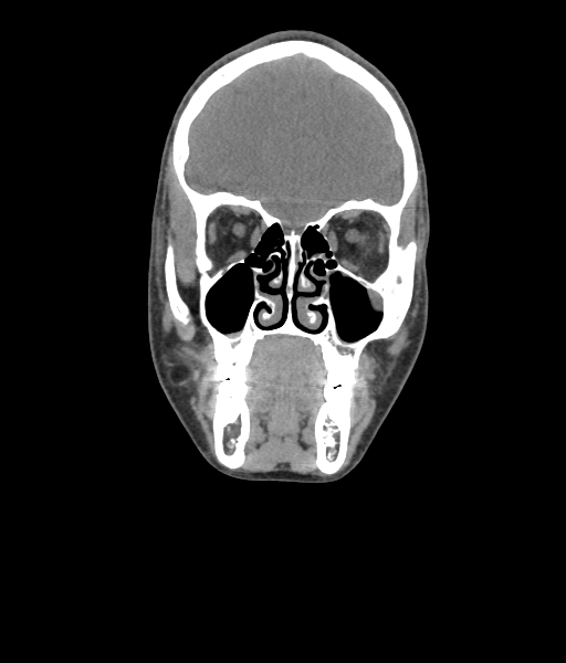 Nasal pyogenic granuloma (lobular capillary hemangioma) (Radiopaedia 85536-101244 Coronal non-contrast 82).jpg