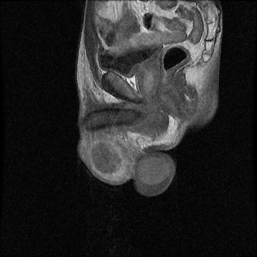File:Necrotizing epididymo-orchitis with intra-testicular abscess (Radiopaedia 29397-29860 Sagittal T1 C+ 11).jpg
