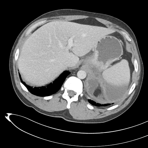 File:Necrotizing pancreatitis with acute necrotic collections (Radiopaedia 38829-41012 B 17).png