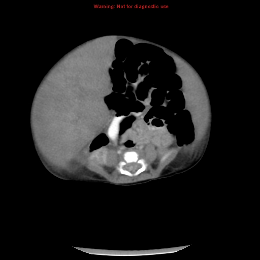 File:Neonatal neuroblastoma (Radiopaedia 9564-10223 A 35).jpg