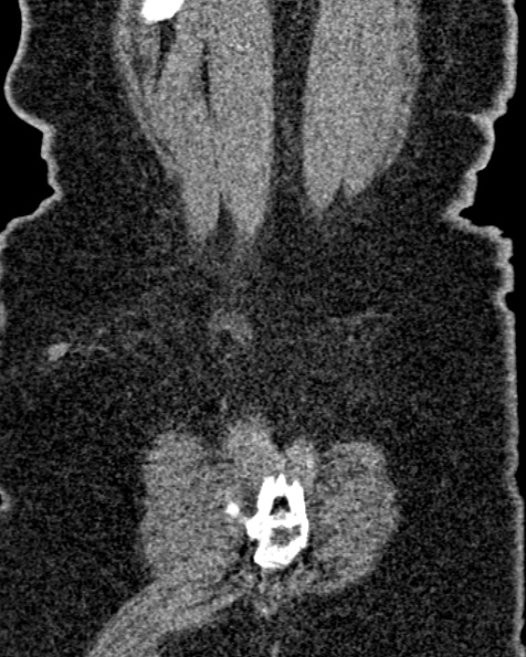 File:Nephrostomy for urosepsis (Radiopaedia 26180-26330 non-contrast 82).jpg