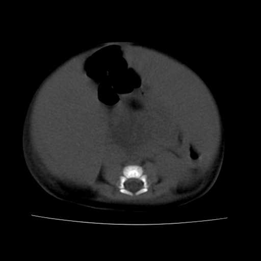 File:Neuroblastoma (Radiopaedia 20876-20799 Axial non-contrast 16).jpg