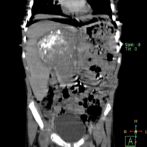 File:Neuroblastoma (Radiopaedia 24751-25016 B 12).jpg