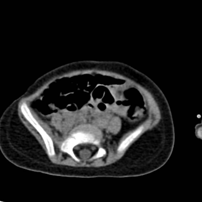 Neuroblastoma with skull metastases (Radiopaedia 30326-30960 Axial non-contrast 44).jpg
