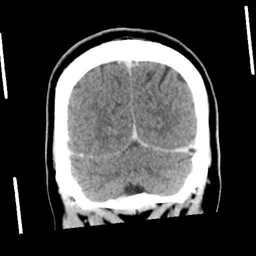 Neurocysticercosis - granular nodular (Radiopaedia 42786-45957 Coronal C+ 53).png