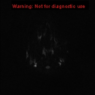 File:Neurofibromatosis type 1 with optic nerve glioma (Radiopaedia 16288-15965 Axial DWI 72).jpg