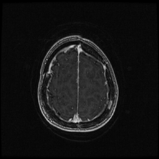 Neurofibromatosis type 2 (Radiopaedia 45229-49244 Axial T1 C+ 96).png