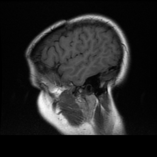 File:Neurofibromatosis type 2 (Radiopaedia 45229-49244 Sagittal T1 18).png