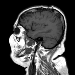File:Neurofibromatosis type 2 (Radiopaedia 8713-9518 Sagittal T1 15).jpg