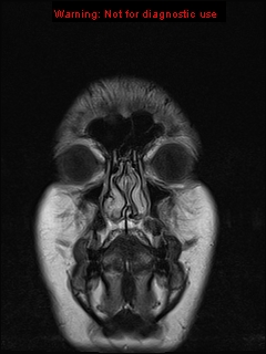 File:Neuroglial cyst (Radiopaedia 10713-11184 Coronal FLAIR 24).jpg