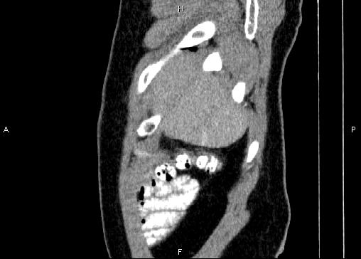 Non-syndromic pancreatic endocrine tumor (Radiopaedia 86958-103178 E 6).jpg