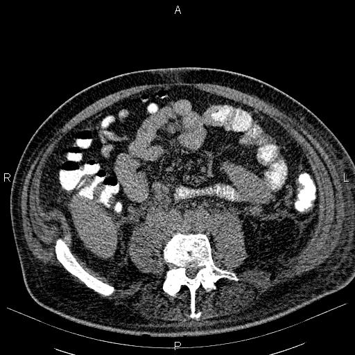File:Non Hodgkin lymphoma in a patient with ankylosing spondylitis (Radiopaedia 84323-99621 Axial non-contrast 43).jpg