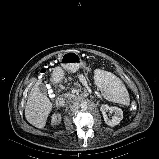File:Non Hodgkin lymphoma in a patient with ankylosing spondylitis (Radiopaedia 84323-99621 B 40).jpg