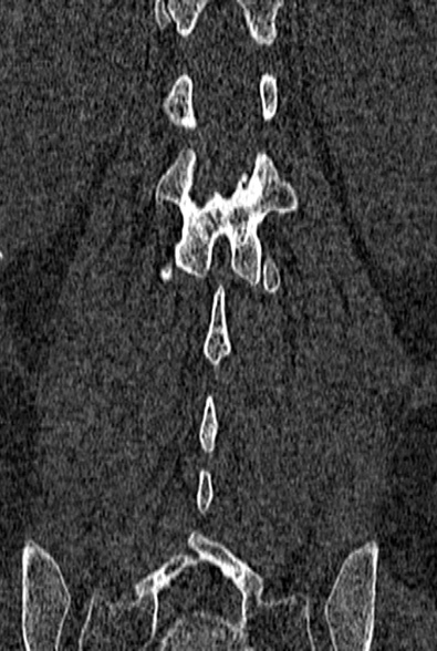 Normal CT lumbar spine (Radiopaedia 53981-60118 Coronal bone window 53).jpg