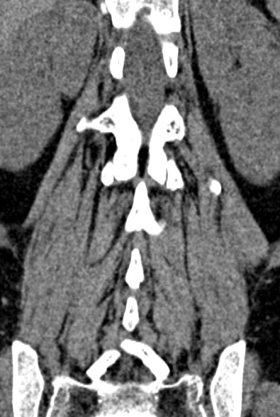 Normal CT lumbar spine (Radiopaedia 53981-60118 F 69).jpg