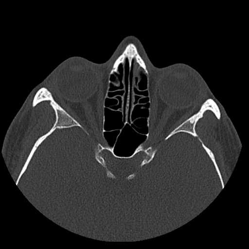 Normal CT paranasal sinuses (Radiopaedia 42286-45390 Axial bone window 45).jpg