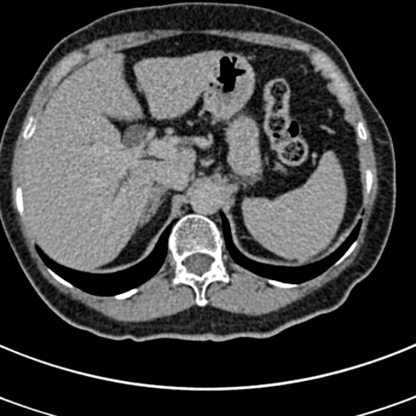 File:Normal CT split bolus study of the renal tract (Radiopaedia 48631-53634 Axial split bolus 10).jpg