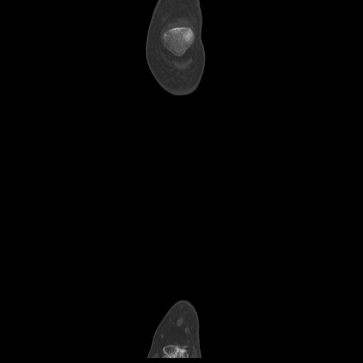 Normal CT tibia and fibula (Radiopaedia 51195-56848 Coronal non-contrast 15).jpg